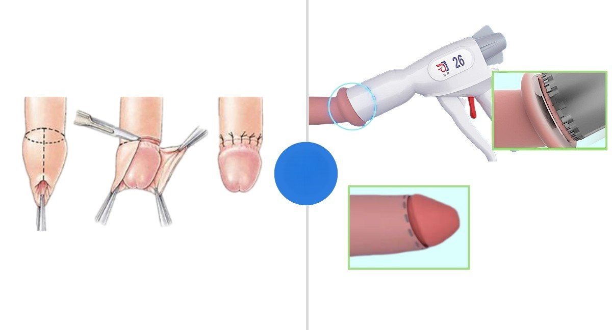 บริการรับขลิบหนังหุ้มปลาย - Lover Clinic