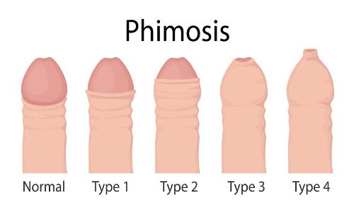 บริการรับขลิบหนังหุ้มปลาย - Lover Clinic