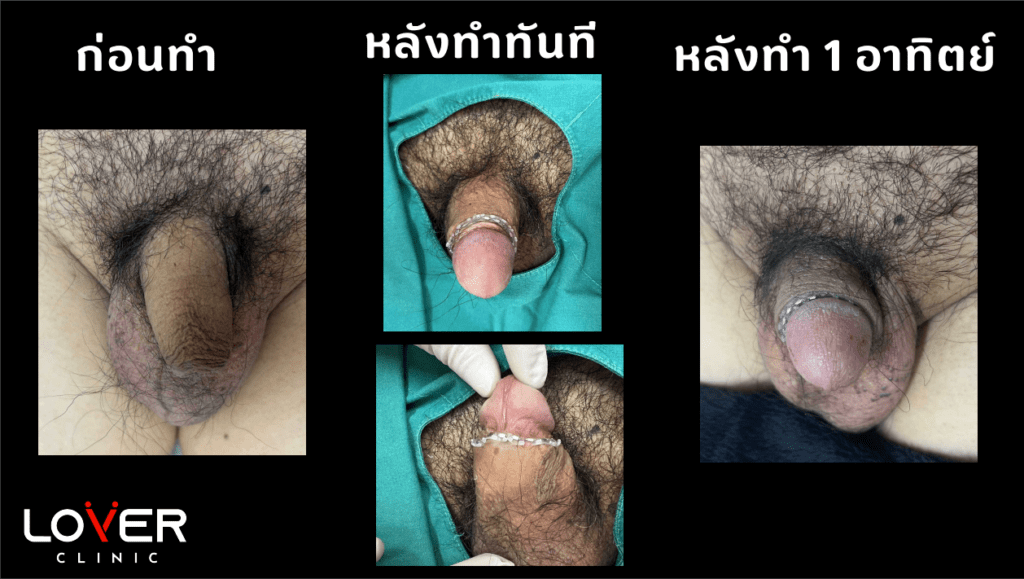 ขลิบไร้เลือดคืออะไร? เทคนิคที่ทำให้การขลิบไม่เจ็บอีกต่อไป