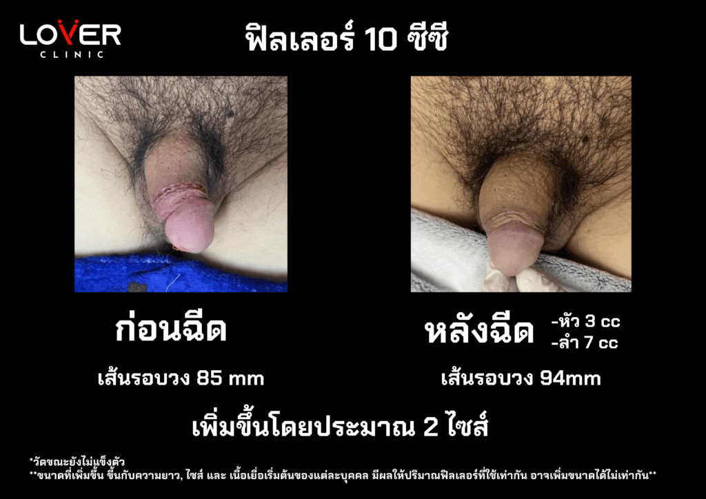 รีวิวเพิ่มขนาดน้องชายที่ Lover Clinic โคราช ปลอดภัยหรือไม่ คุ้มค่าหรือเปล่า