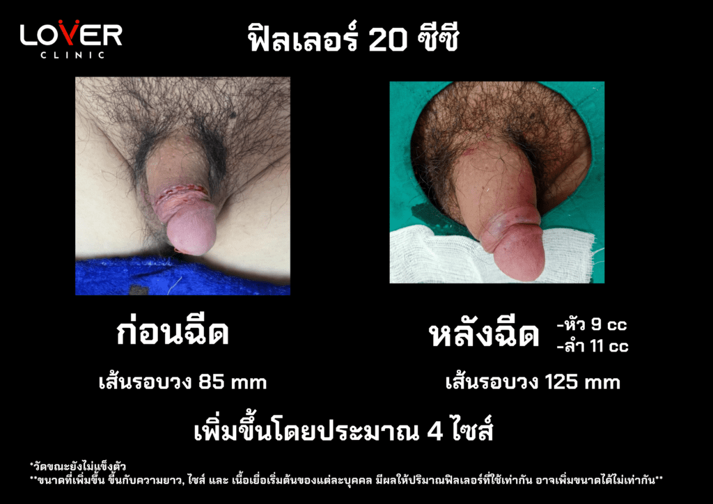รีวิวเพิ่มขนาดน้องชายที่ Lover Clinic โคราช ปลอดภัยหรือไม่ คุ้มค่าหรือเปล่า