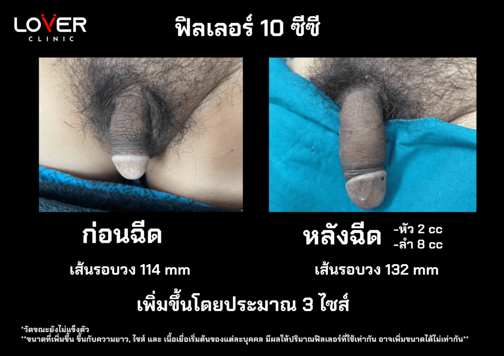 รีวิวเพิ่มขนาดน้องชายที่ Lover Clinic โคราช ปลอดภัยหรือไม่ คุ้มค่าหรือเปล่า