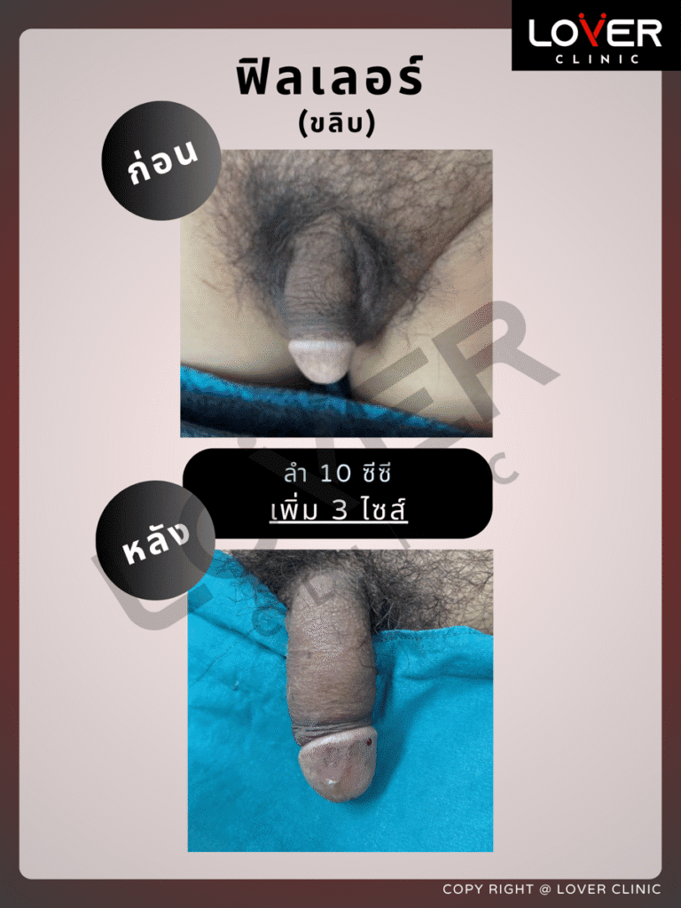 ผลลัพธ์ฟิลเลอร์ 10cc พร้อมขลิบ ที่ Lover Clinic