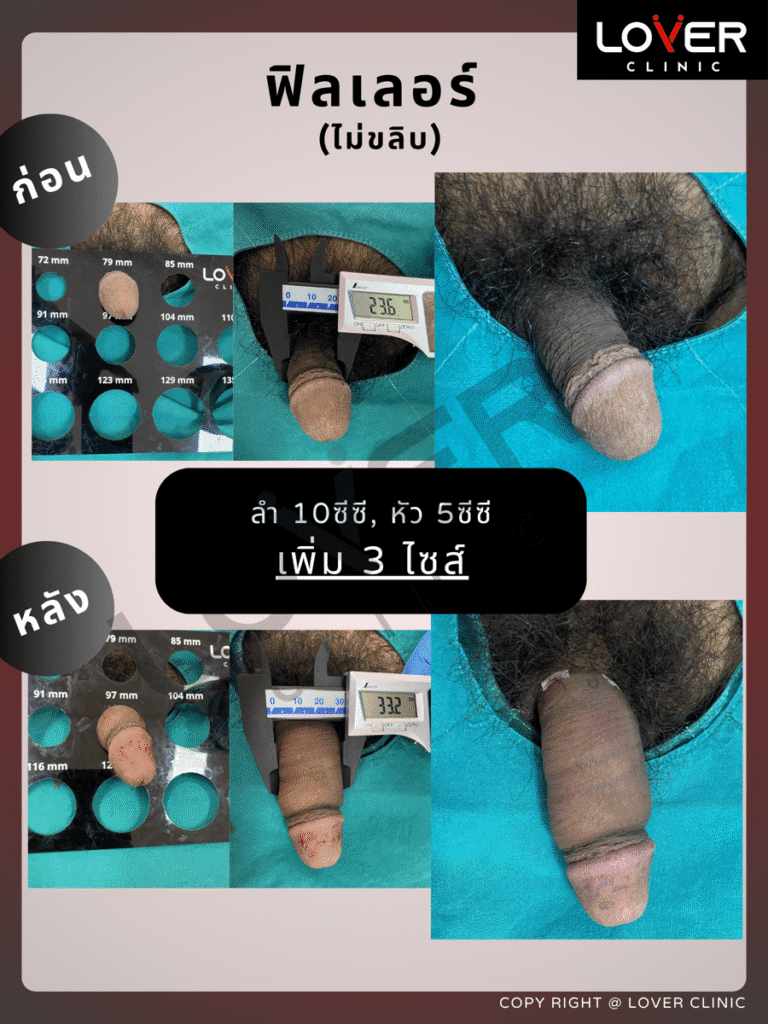 ผลลัพธ์ฟิลเลอร์ 10cc ไม่ขลิบ ที่ Lover Clinic