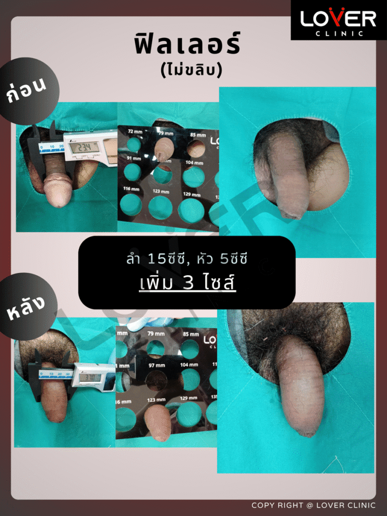 ผลลัพธ์ฟิลเลอร์ 20cc ไม่ขลิบ ที่ Lover Clinic