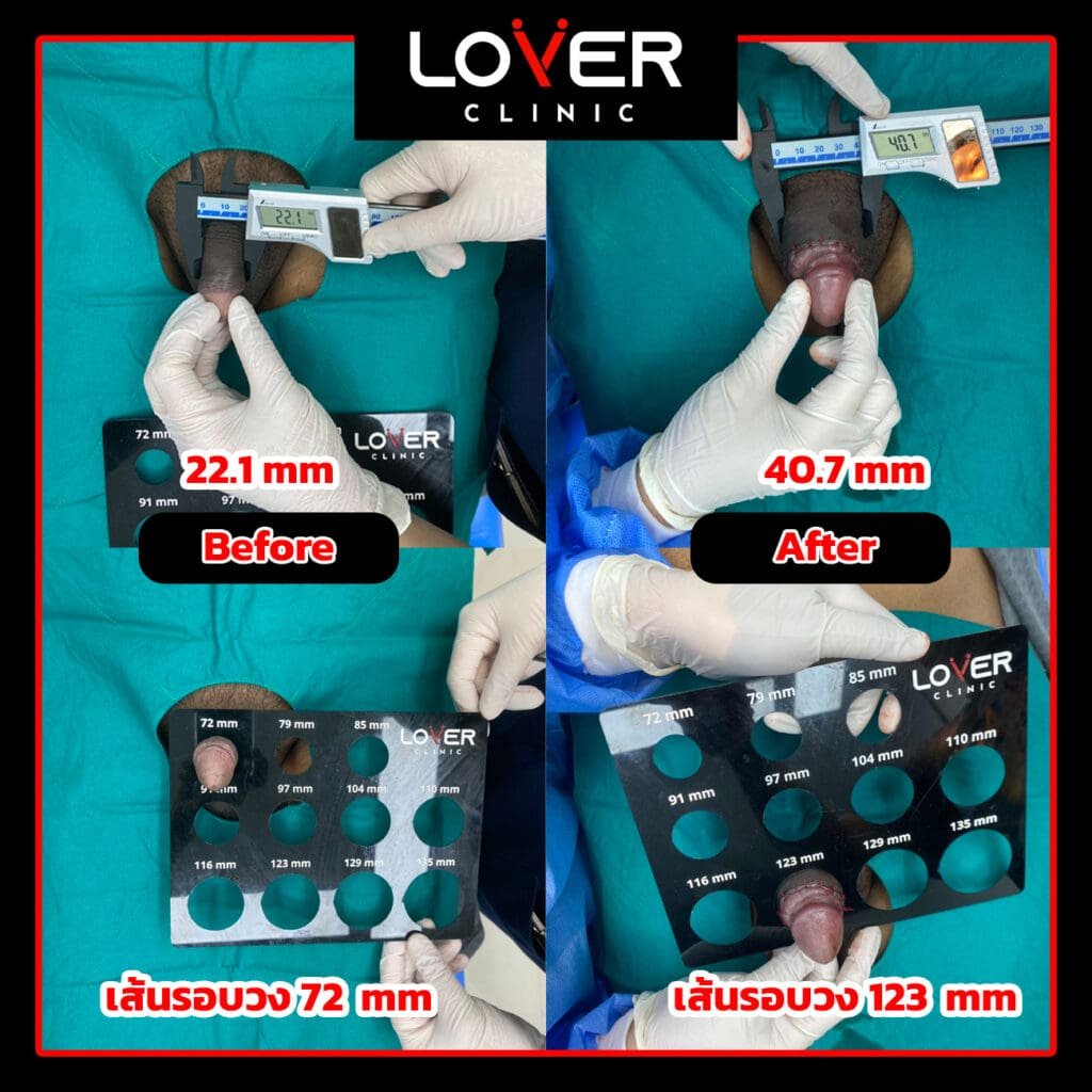 ผลลัพธ์เพิ่มขนาดเนื้อเยื่อเทียม ที่ Lover Clinic รูปที่ 1