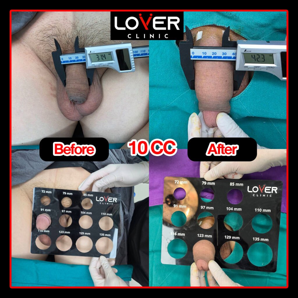 ผลลัพธ์ฟิลเลอร์เพิ่มขนาดไม่ขลิบ ที่ Lover Clinic รูปที่ 1