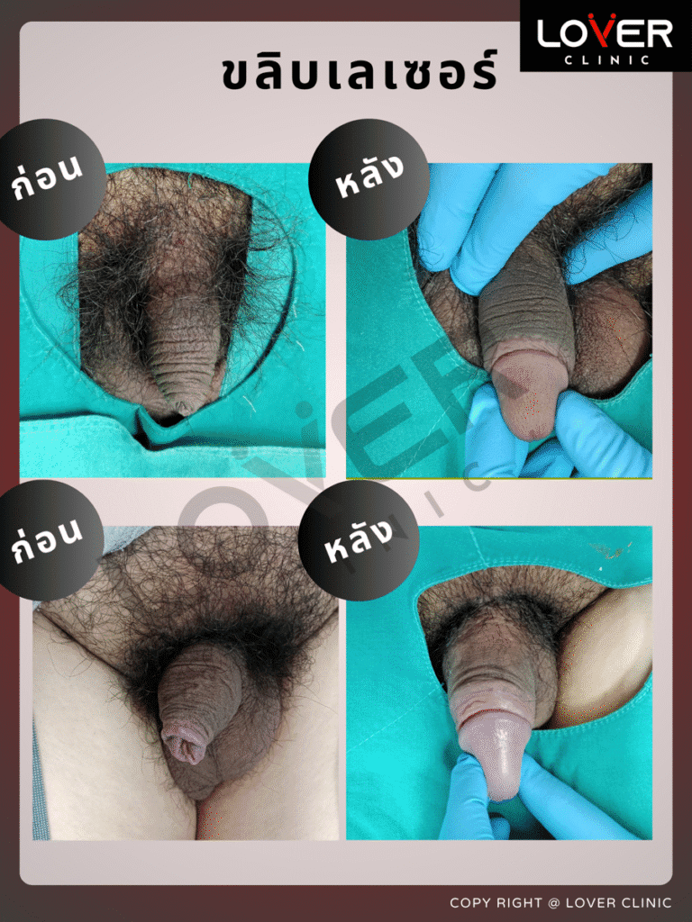 ผลลัพธ์ขลิบเลเซอร์ Sleeve Technique ที่ Lover Clinic รูปที่ 2