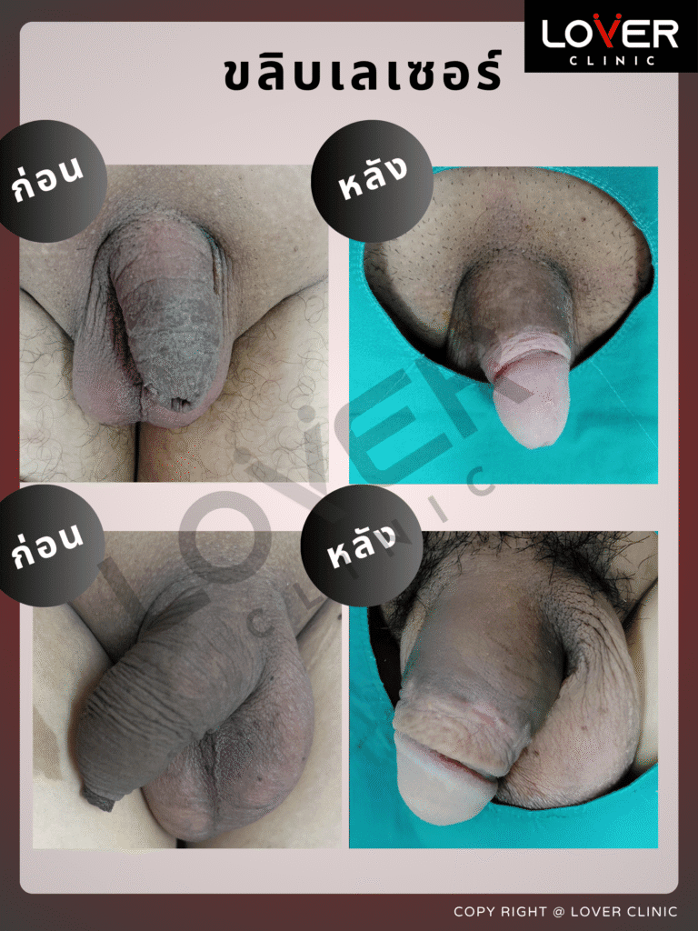 ผลลัพธ์ขลิบเลเซอร์ Sleeve Technique ที่ Lover Clinic รูปที่ 3