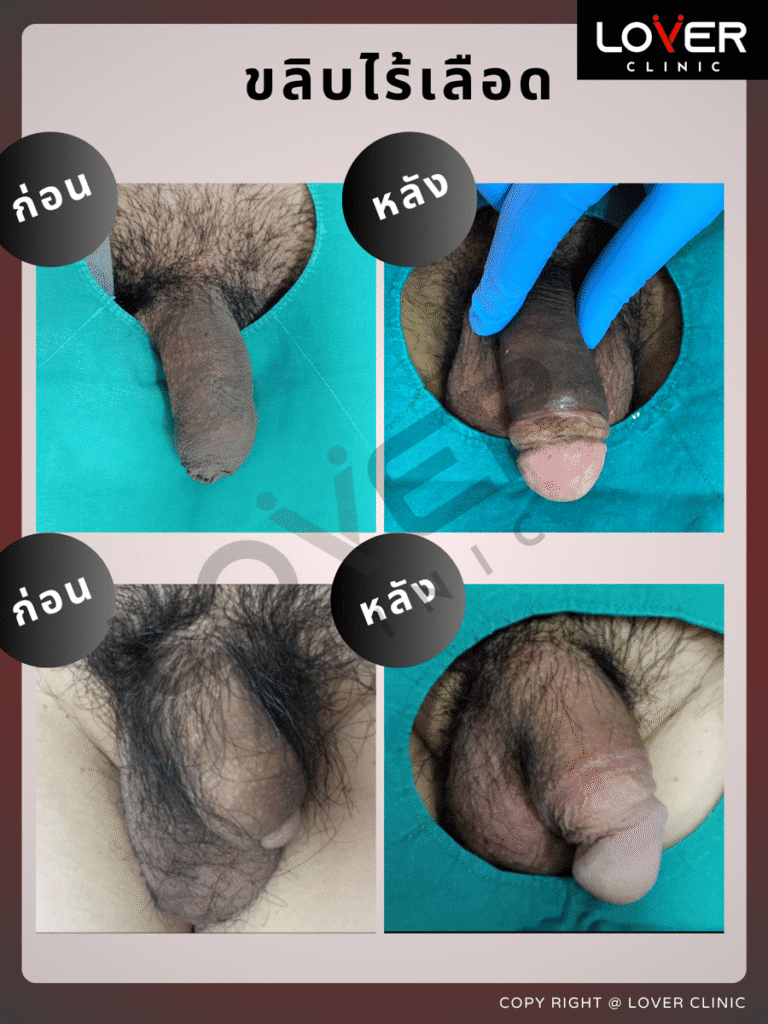 ผลลัพธ์ Pearling ใส่ลูกปัด ที่ Lover Clinic รูปที่ 1