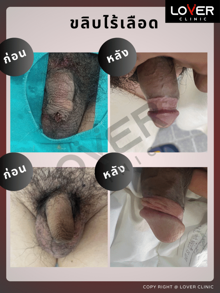 ผลลัพธ์ขลิบไร้เลือด ที่ Lover Clinic รูปที่ 10