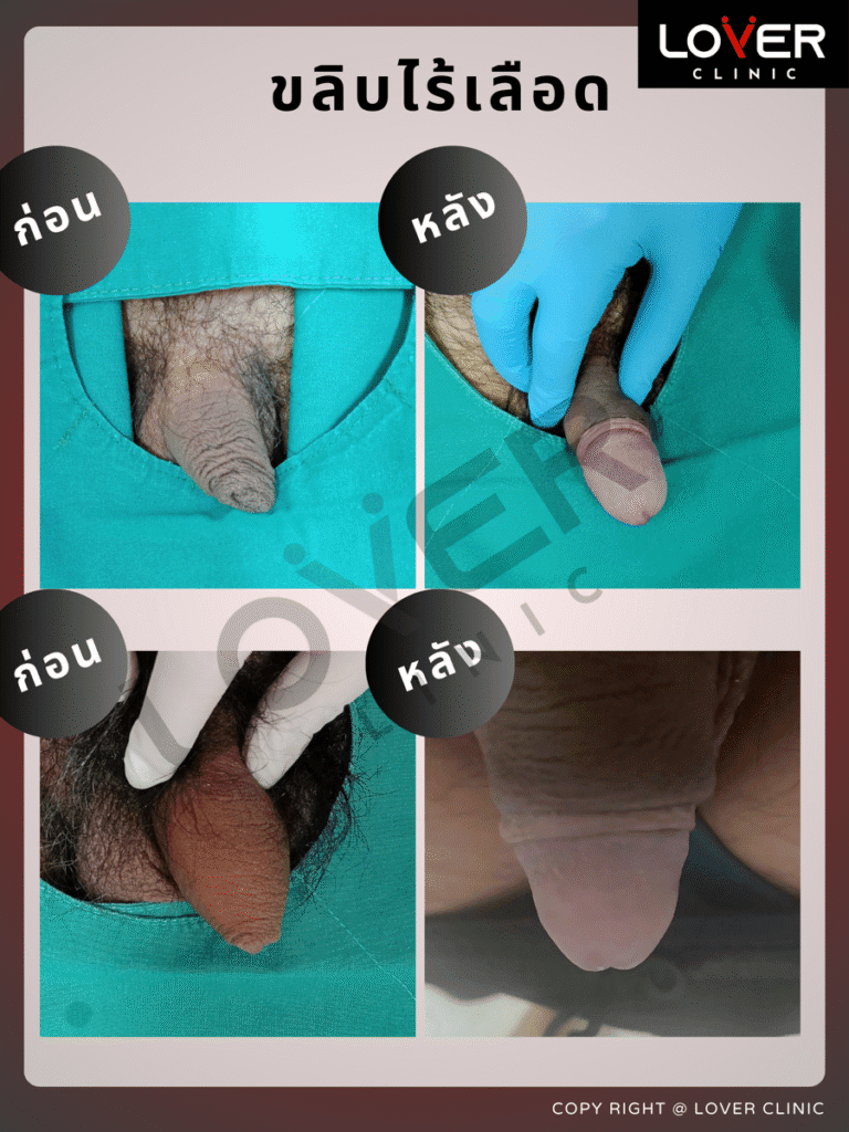 ผลลัพธ์ขลิบไร้เลือด ที่ Lover Clinic รูปที่ 2