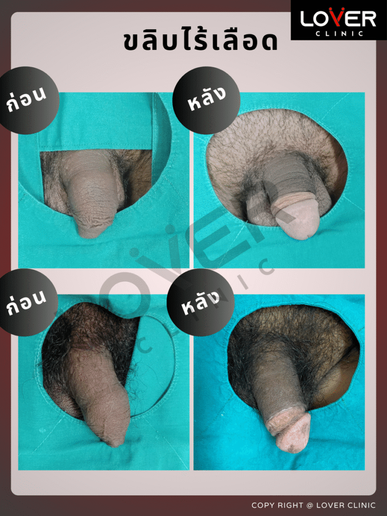 ผลลัพธ์ขลิบไร้เลือด ที่ Lover Clinic รูปที่ 3