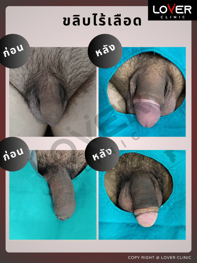 ผลลัพธ์ขลิบไร้เลือด ที่ Lover Clinic รูปที่ 4