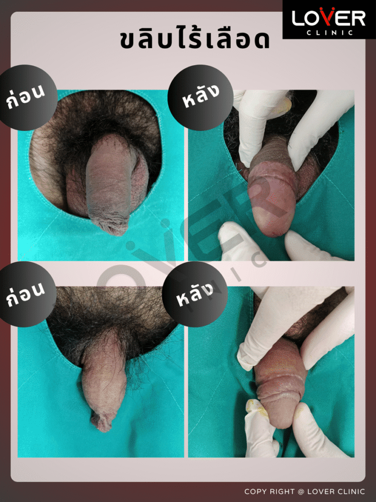 ผลลัพธ์ขลิบไร้เลือด ที่ Lover Clinic รูปที่ 5