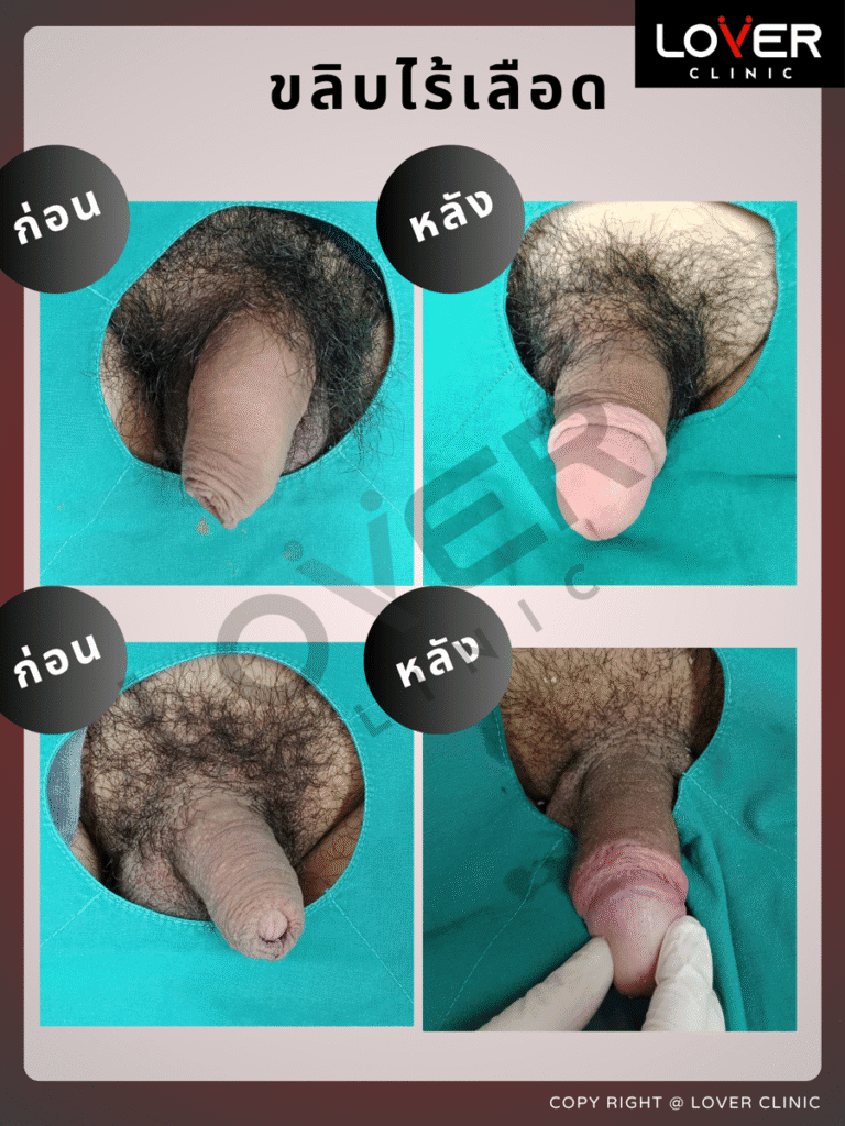 ผลลัพธ์ขลิบไร้เลือด ที่ Lover Clinic รูปที่ 6