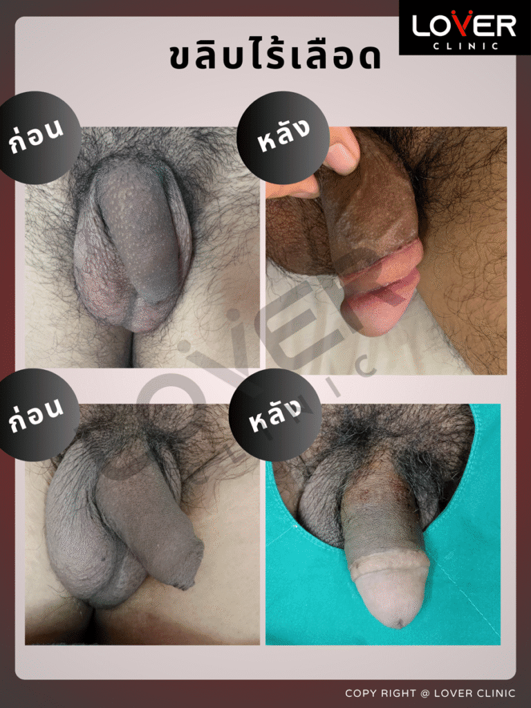 ผลลัพธ์ขลิบไร้เลือด ที่ Lover Clinic รูปที่ 7