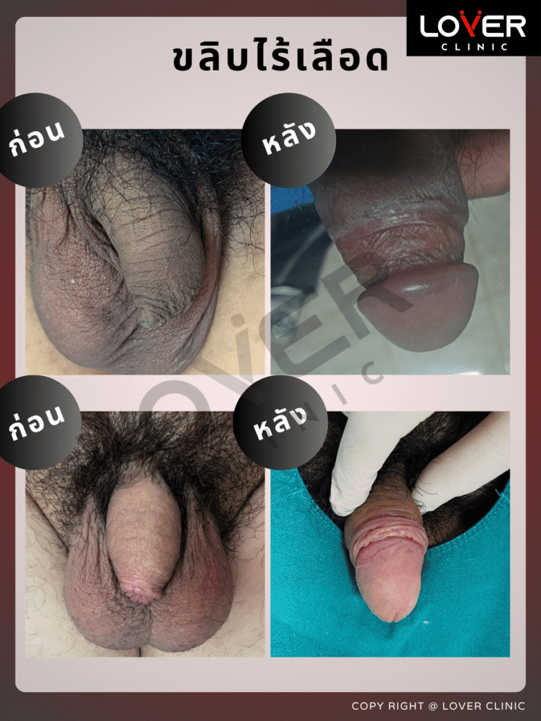 ผลลัพธ์ขลิบไร้เลือด ที่ Lover Clinic รูปที่ 9