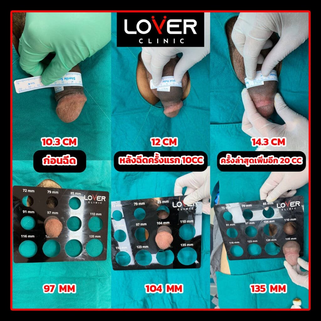 ผลลัพธ์ฟิลเลอร์เพิ่มขนาดพร้อมขลิบ ที่ Lover Clinic รูปที่ 1