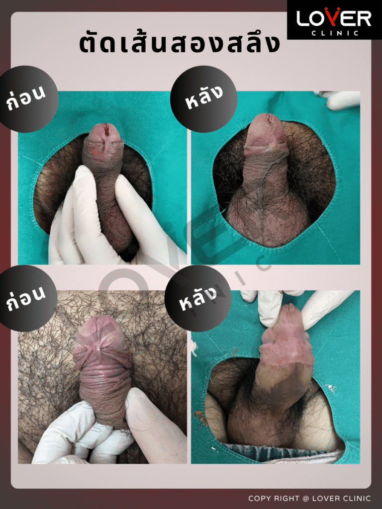 ผลลัพธ์ตัดเส้นสองสลึง ที่ Lover Clinic รูปที่ 2