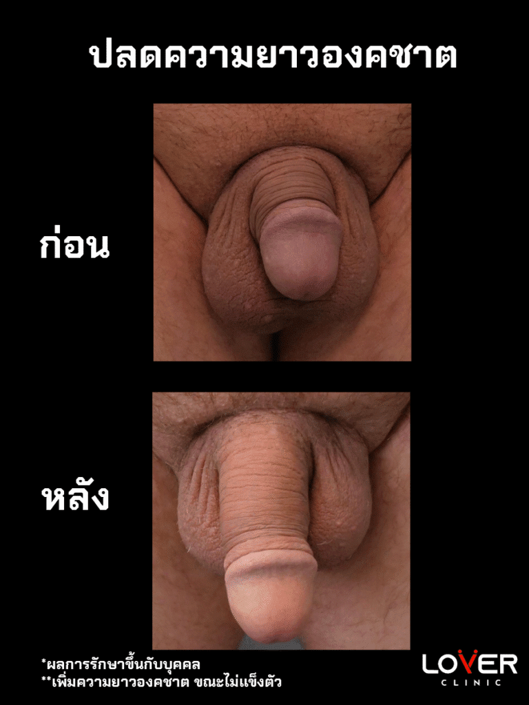 ผลลัพธ์ปลดความยาวชั่วคราว ที่ Lover Clinic รูปที่ 1