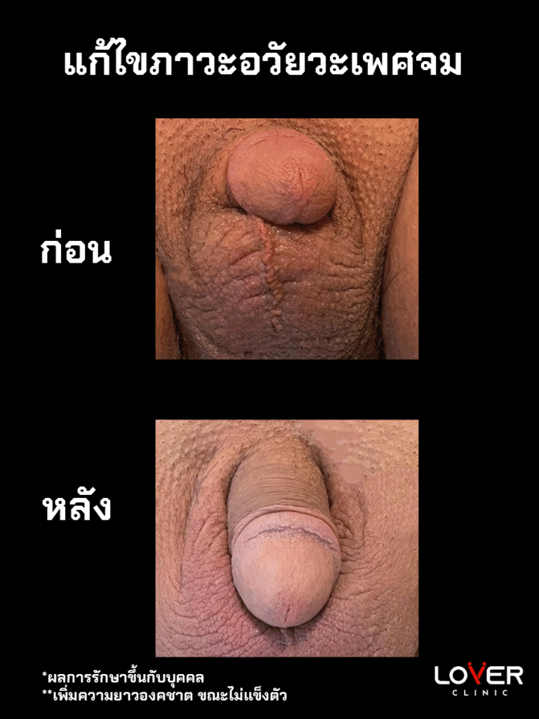 ผลลัพธ์ปลดความยาวชั่วคราว ที่ Lover Clinic รูปที่ 2