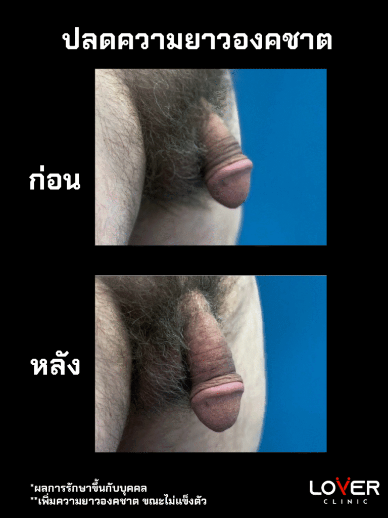 ผลลัพธ์ปลดความยาวชั่วคราว ที่ Lover Clinic รูปที่ 3