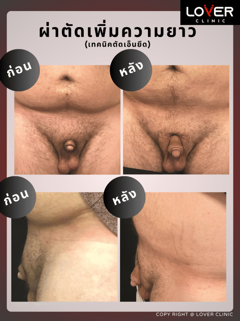 ผลลัพธ์ผ่าตัดปลดความยาวถาวร ที่ Lover Clinic รูปที่ 3