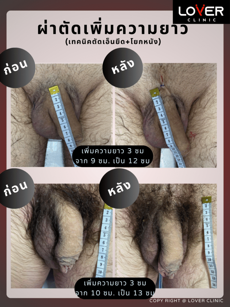 ผลลัพธ์ผ่าตัดปลดความยาวถาวร ที่ Lover Clinic รูปที่ 1