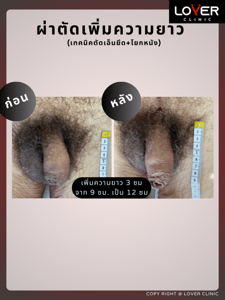 ผลลัพธ์ผ่าตัดปลดความยาวถาวร ที่ Lover Clinic รูปที่ 2