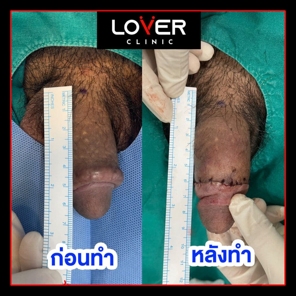 ผลลัพธ์เพิ่มขนาดเนื้อเยื่อเทียม ที่ Lover Clinic รูปที่ 2