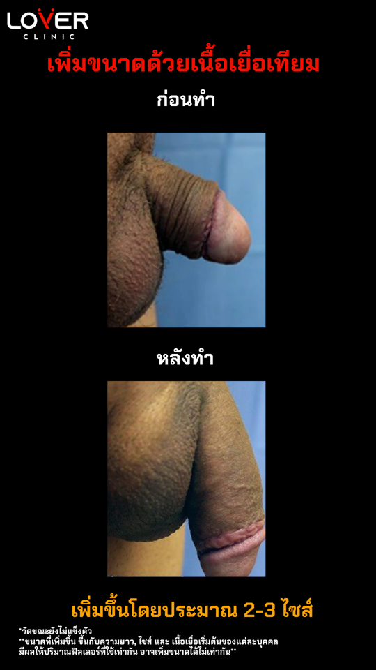 ผลลัพธ์เพิ่มขนาดเนื้อเยื่อเทียม ที่ Lover Clinic รูปที่ 3