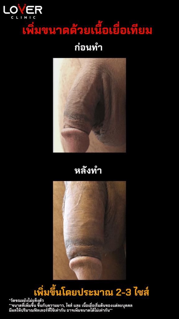 ผลลัพธ์เพิ่มขนาดเนื้อเยื่อเทียม ที่ Lover Clinic รูปที่ 4