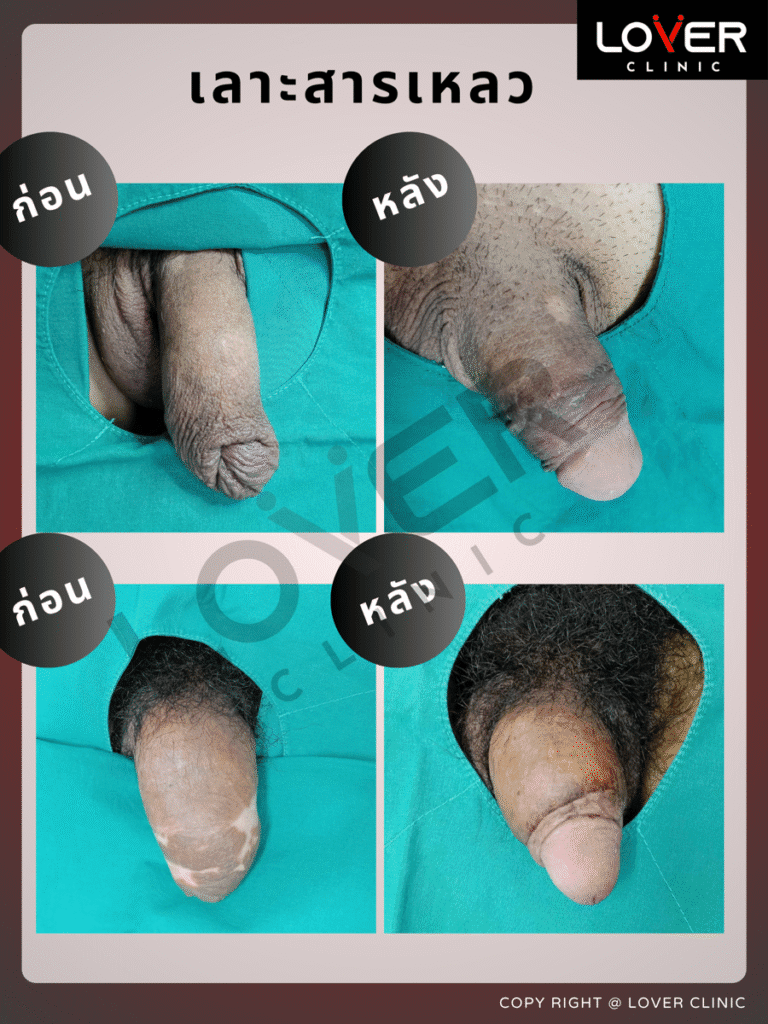 ผลลัพธ์เลาะ/ขูดสารแปลกปลอม ที่ Lover Clinic รูปที่ 1