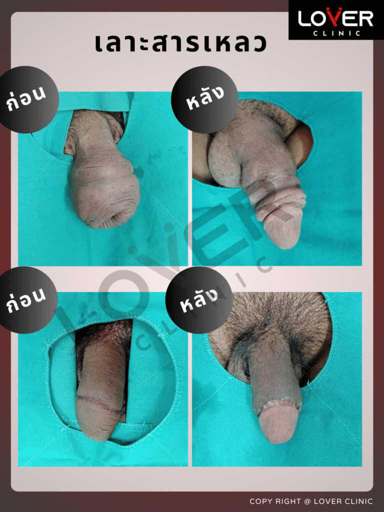 ผลลัพธ์เลาะ/ขูดสารแปลกปลอม ที่ Lover Clinic รูปที่ 2