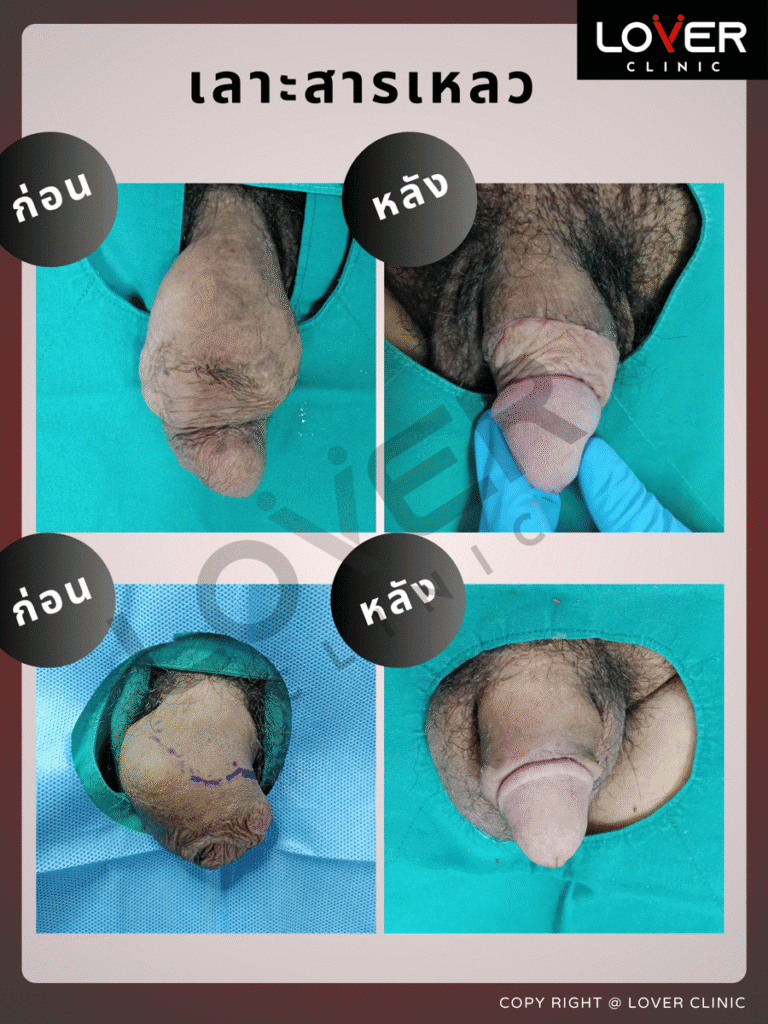 ผลลัพธ์เลาะ/ขูดสารแปลกปลอม ที่ Lover Clinic รูปที่ 3