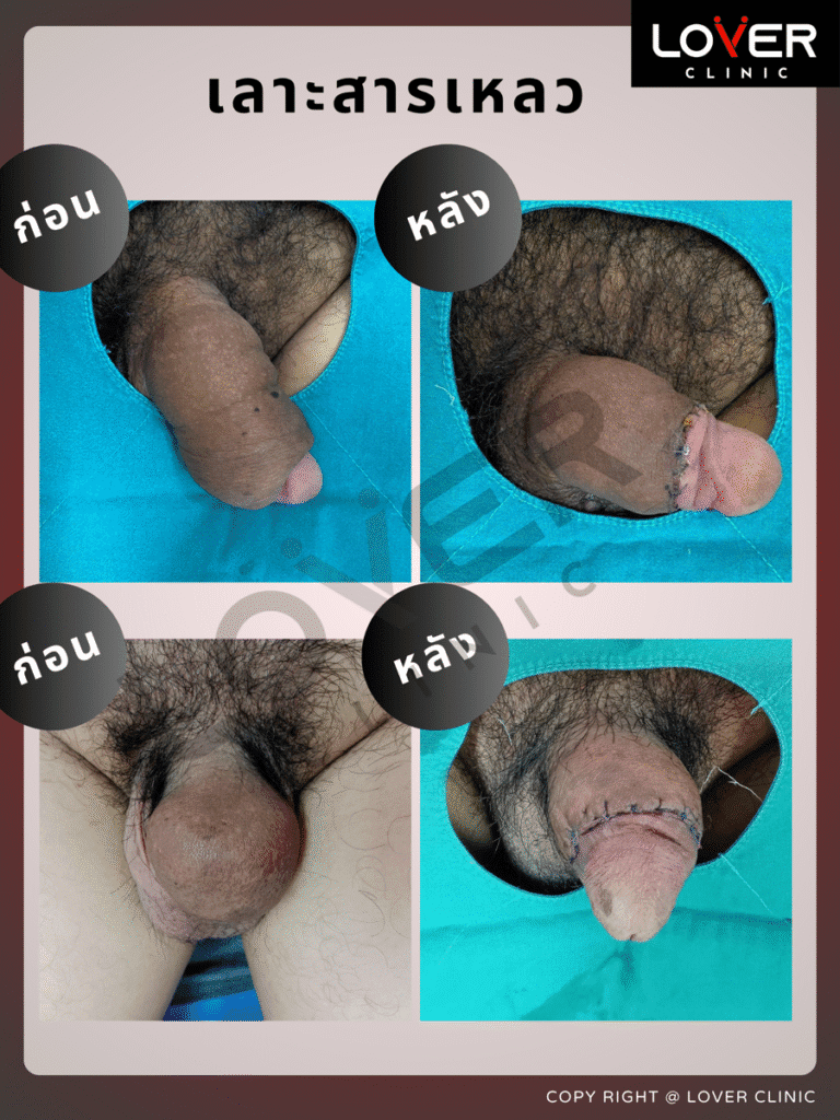 ผลลัพธ์เลาะ/ขูดสารแปลกปลอม ที่ Lover Clinic รูปที่ 4