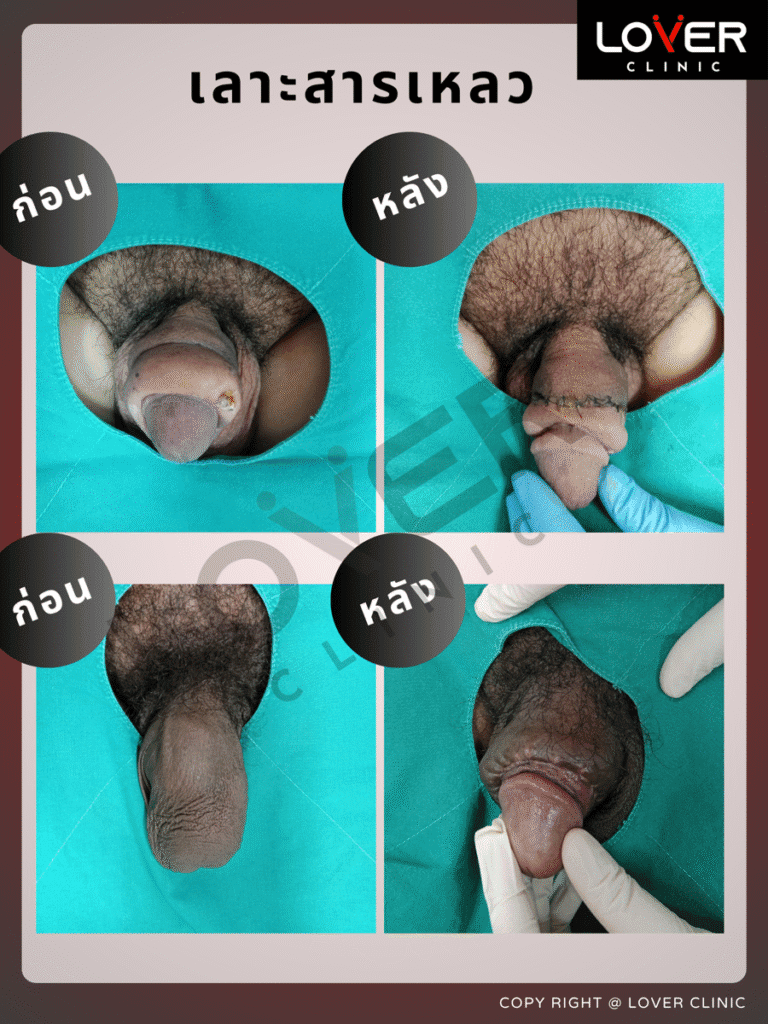 ผลลัพธ์เลาะ/ขูดสารแปลกปลอม ที่ Lover Clinic รูปที่ 5