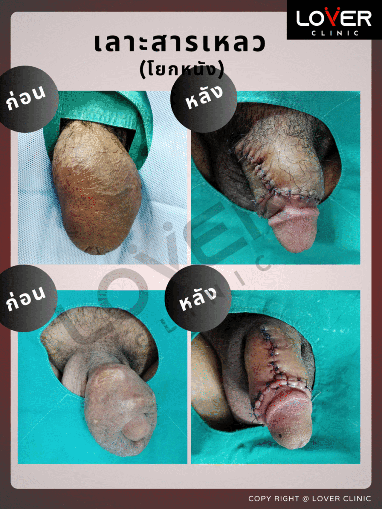 ผลลัพธ์เลาะสารแปลกปลอมพร้อมโยกหนัง ที่ Lover Clinic รูปที่ 1