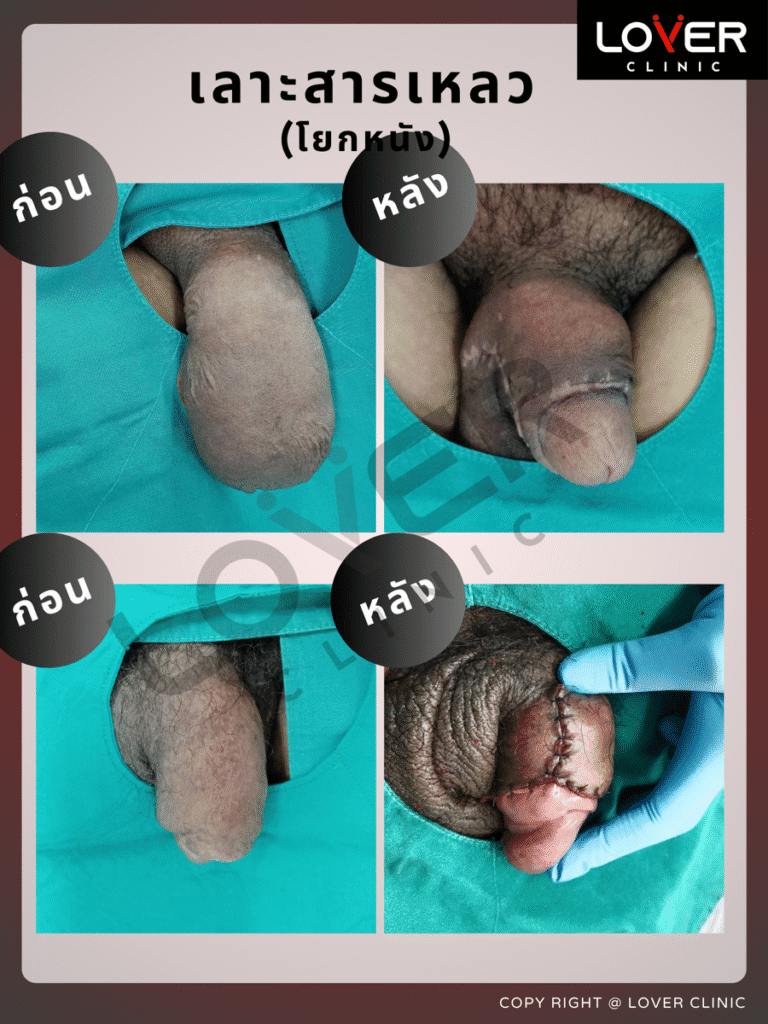 ผลลัพธ์เลาะสารแปลกปลอมพร้อมโยกหนัง ที่ Lover Clinic รูปที่ 2