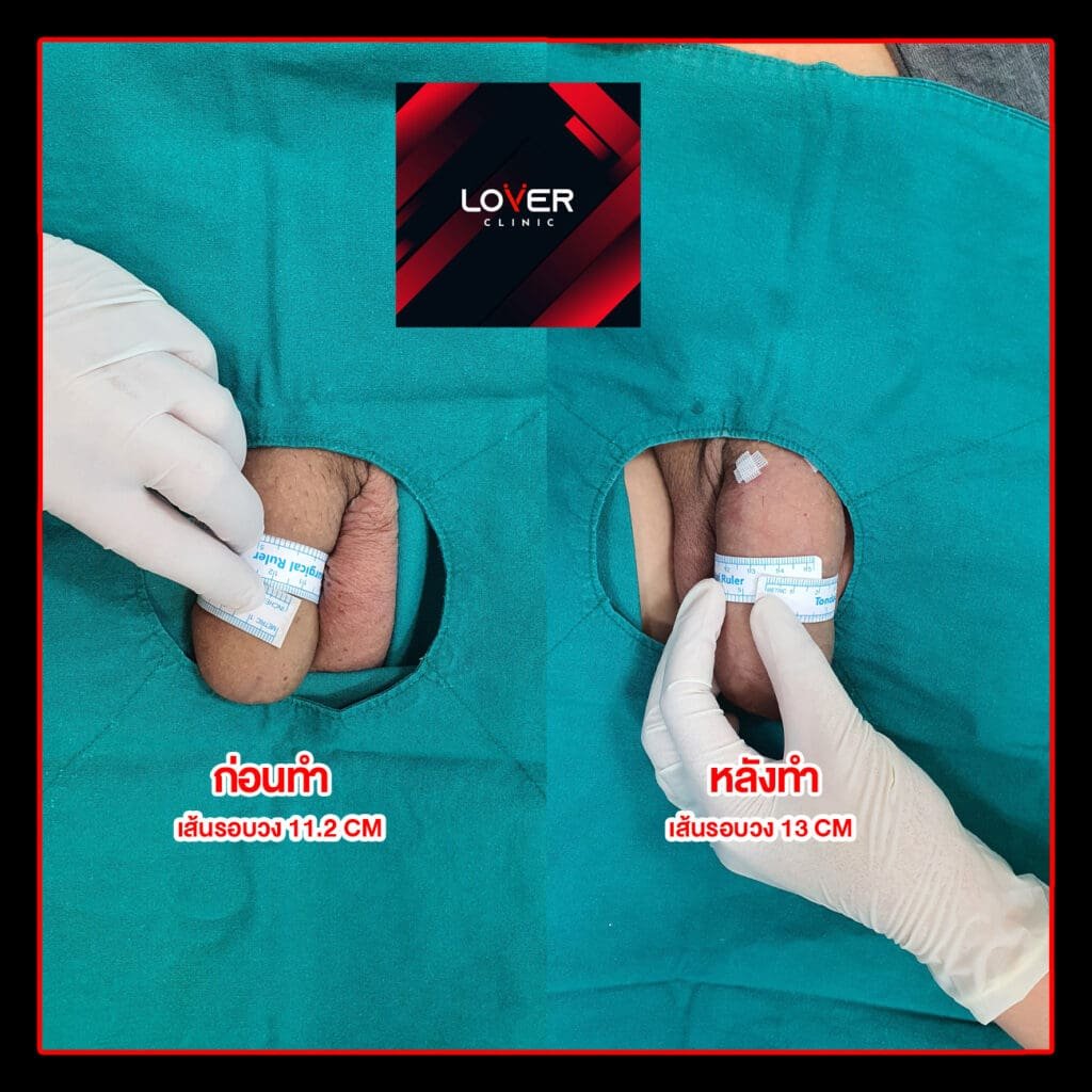 ผลลัพธ์ฟิลเลอร์เพิ่มขนาดไม่ขลิบ ที่ Lover Clinic รูปที่ 2